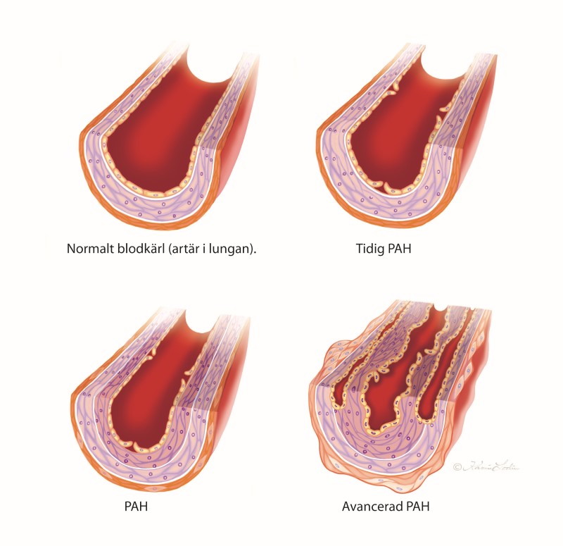 PAH - pulmonell arteriell hypertension